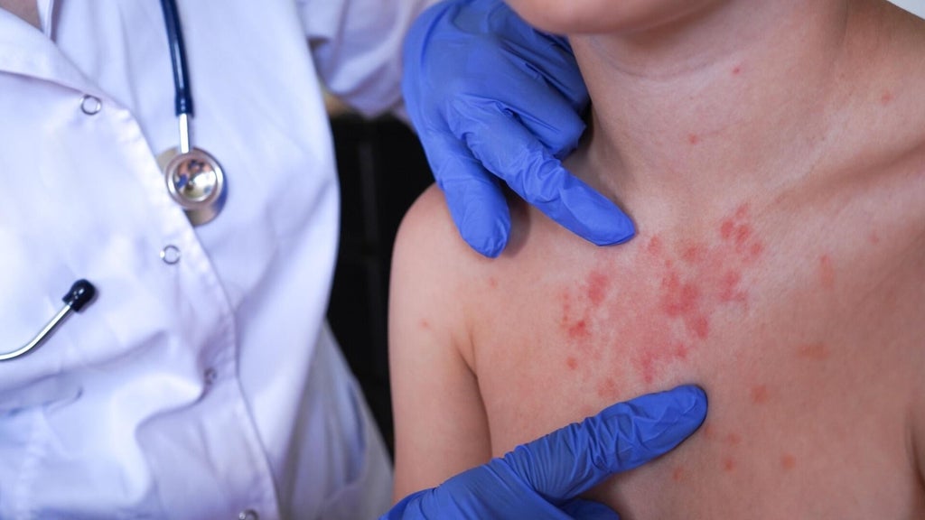 Minnesota's 80 measles cases this year are the most since 1990, health officials say — Owatonna Health news